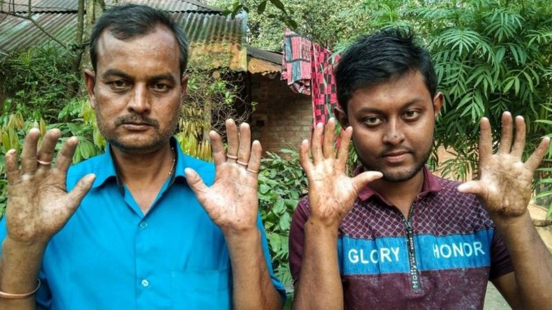 एउटा यस्तो बाङ्ग्लादेशी परिवार जहाँ सबै पुरुष सदस्यका औँलामा कुनै छाप छैन
